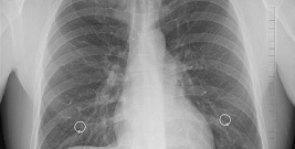 Mieszkańcy powiatu sanockiego, brzozowskiego i leskiego mogą skorzystać z darmowej tomografii płuc